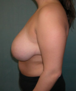 Breast Reduction for Women