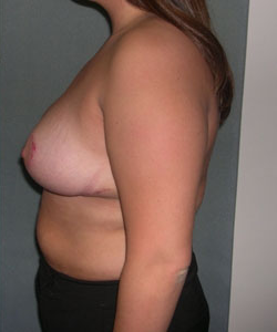 Breast Reduction for Women