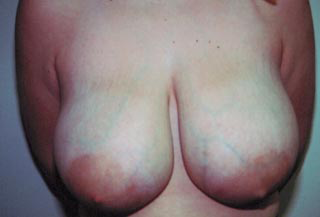 Breast Reduction for Women Before Photo Breast Reduction for Women