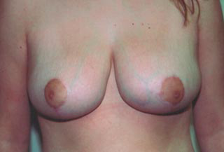 Breast Reduction for Women After Photo Breast Reduction for Women
