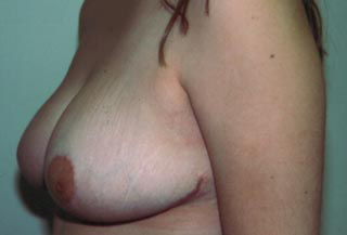 Breast Reduction for Women