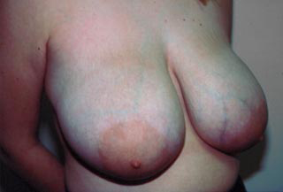 Breast Reduction for Women Before Photo Breast Reduction for Women