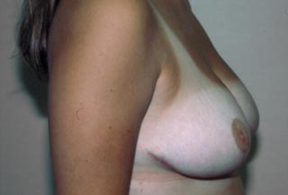 Breast Reduction for Women After Photo Breast Reduction for Women