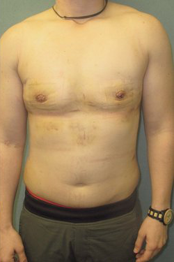 Dr. Blau's patient results for gynecomastia/breast reduction in New York City