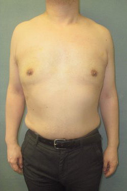 Dr. Blau's patient results for gynecomastia/breast reduction in New York City