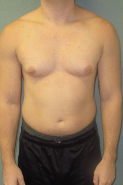 Dr. Blau's patient results for gynecomastia/breast reduction in New York City