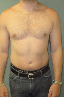 Dr. Blau's patient results for gynecomastia/breast reduction in New York City