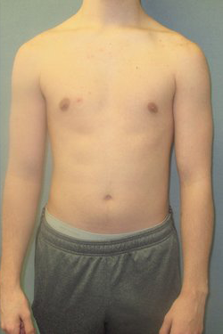 Dr. Blau's patient results for gynecomastia/breast reduction in New York City