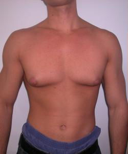 Dr. Blau's patient results for gynecomastia/breast reduction in New York City