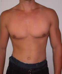 Dr. Blau's patient results for gynecomastia/breast reduction in New York City