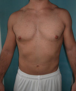 Adults (20-40) Before Photo Adults (20-40)