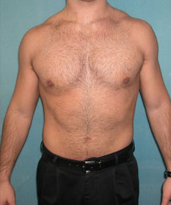 Adults (20-40) After Photo Adults (20-40)