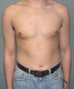 Adults (20-40) After Photo Adults (20-40)