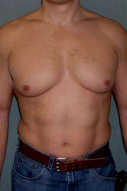 Adults (20-40) Before Photo Adults (20-40)