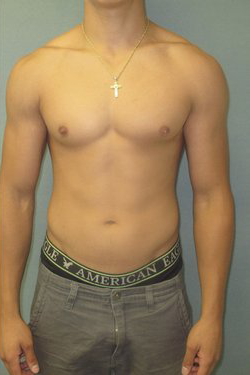 Dr. Blau's patient results for adolescent gynecomastia/breast reduction in New York City