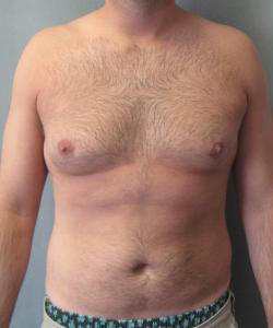 Adults (20-40) Before Photo Adults (20-40)