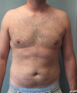Adults (20-40) After Photo Adults (20-40)