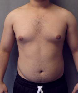 Adults (20-40) Before Photo Adults (20-40)