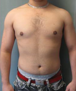 Adults (20-40) After Photo Adults (20-40)