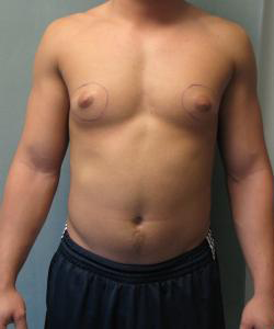 Adults (20-40) Before Photo Adults (20-40)