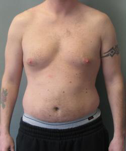 Adults (20-40) Before Photo Adults (20-40)