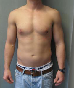 Adults (20-40) After Photo Adults (20-40)