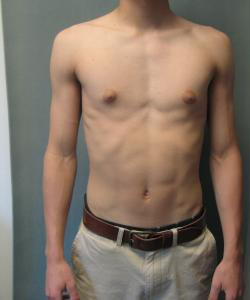 Adolescents (14-19) Before Photo Adolescents (14-19)