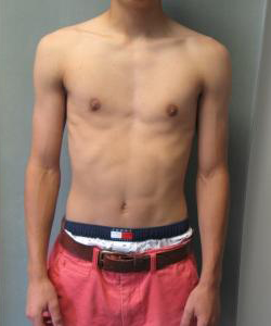 Adolescents (14-19) After Photo Adolescents (14-19)