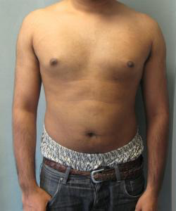 Adults (20-40) Before Photo Adults (20-40)
