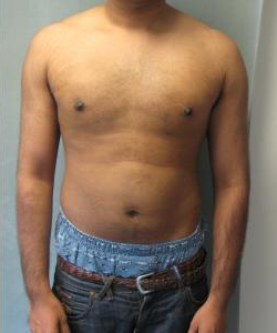 Adults (20-40) After Photo Adults (20-40)
