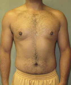 Asymmetric/Unilateral After Photo Asymmetric/Unilateral