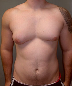 Asymmetrical Gynecomastia, White Plains, NY