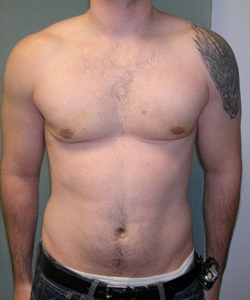 gynecomastia