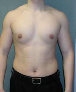 Asymmetric/Unilateral After Photo Asymmetric/Unilateral