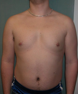 Asymmetric/Unilateral After Photo Asymmetric/Unilateral