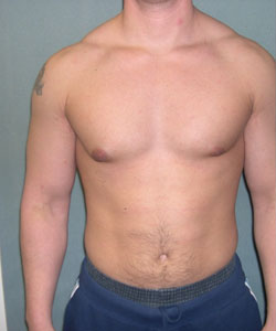 Asymmetric/Unilateral Before Photo Asymmetric/Unilateral