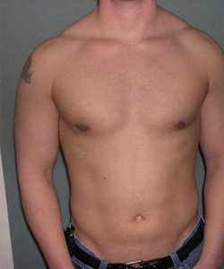 Asymmetric/Unilateral After Photo Asymmetric/Unilateral