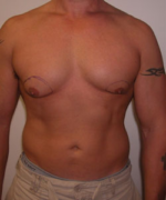 Asymmetric/Unilateral Gynecomastia Surgery