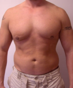 Asymmetric/Unilateral Gynecomastia Surgery