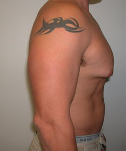 Asymmetric/Unilateral Gynecomastia Surgery