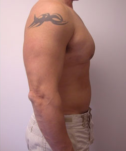 Asymmetric/Unilateral Gynecomastia Surgery