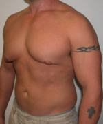 Asymmetric/Unilateral Gynecomastia Surgery