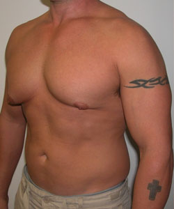 Asymmetric/Unilateral Gynecomastia Surgery