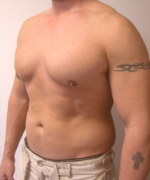 Asymmetric/Unilateral Gynecomastia Surgery