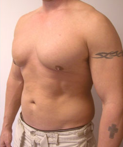 Asymmetric/Unilateral Gynecomastia Surgery