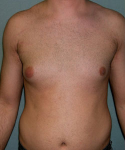 Asymmetric/Unilateral Before Photo Asymmetric/Unilateral