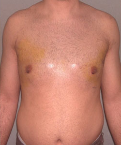 Asymmetric/Unilateral After Photo Asymmetric/Unilateral