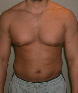Asymmetric/Unilateral Before Photo Asymmetric/Unilateral