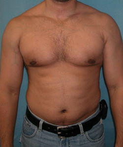 Asymmetric/Unilateral After Photo Asymmetric/Unilateral