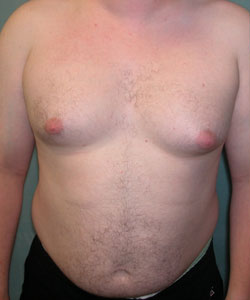 Asymmetric/Unilateral Before Photo Asymmetric/Unilateral